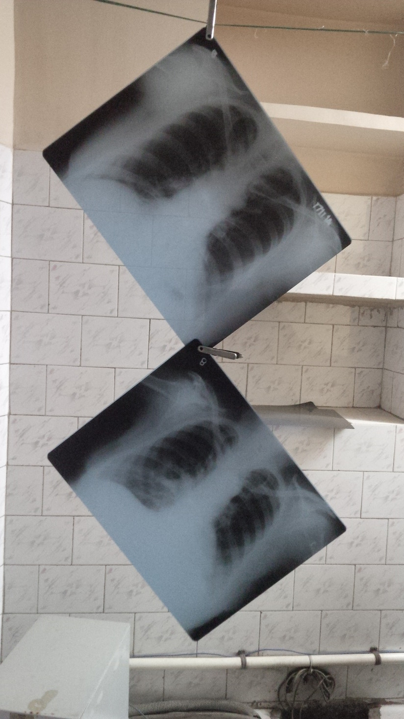 Chest radiography in tuberculosis detection 
